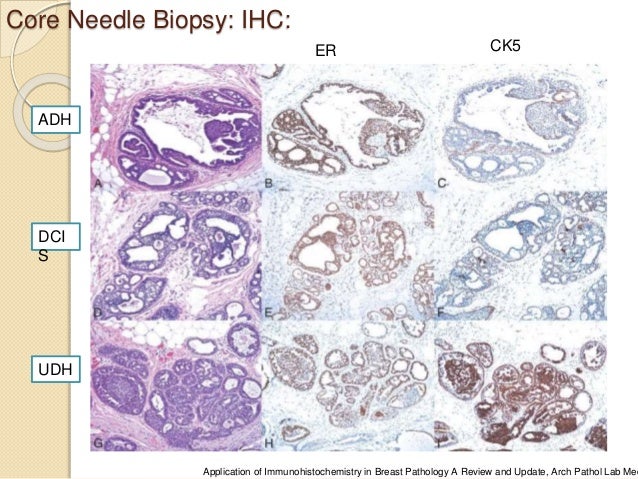 biopsy biopsy breast pathology pathology series Crumps bottom hinton wv history